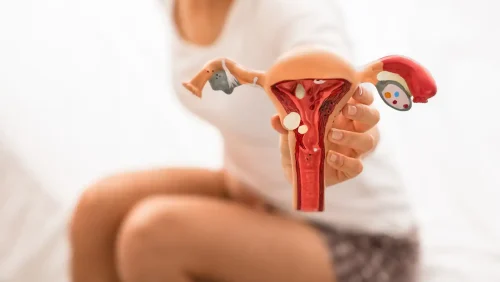 Endometriosis