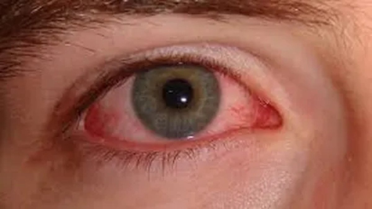 Dengue