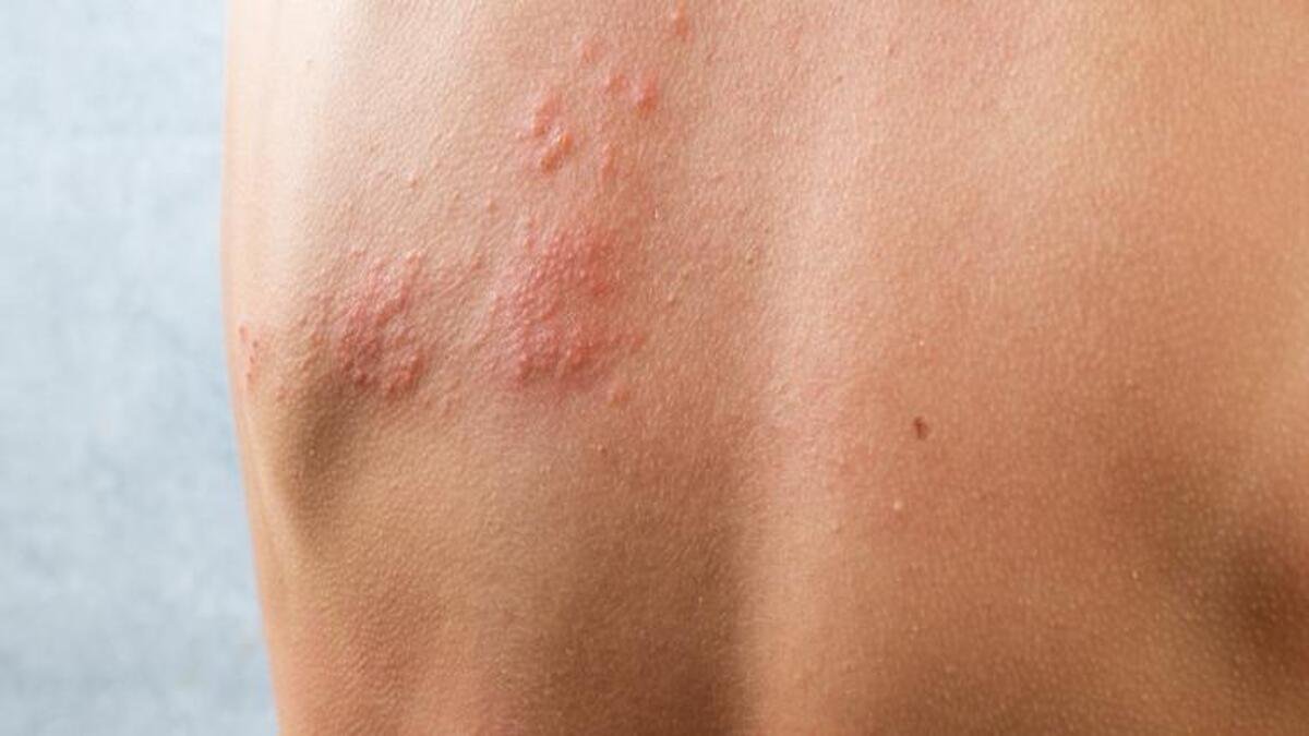Urticaria por calor